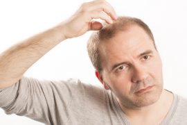 Top 8 Reasons for Premature Balding